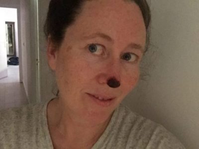 alice morrison adventurer skin cancer